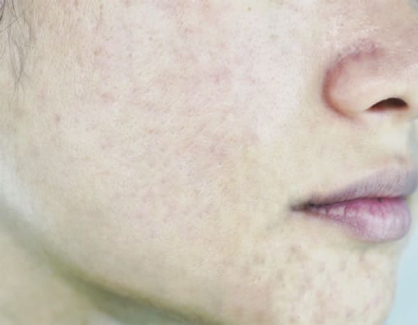 ミレム-ビュートリックの効果　使用後のお肌の状態